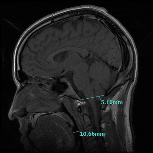 Chapman Clinic Mild Chiari MRI of Atlas Joint