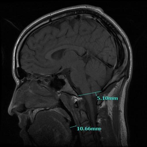 Chapman Clinic Mild Chiari MRI of Atlas Joint